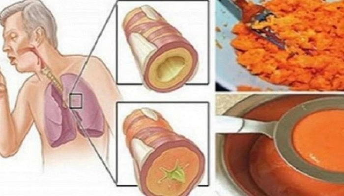 Αρχαίο σπιτικό σιρόπι που αφαιρεί το φλέγμα από τους πνεύμονες και θεραπεύει τον βήχα!